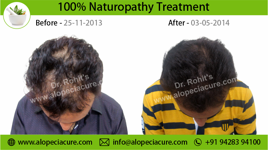 male hair loss treatment